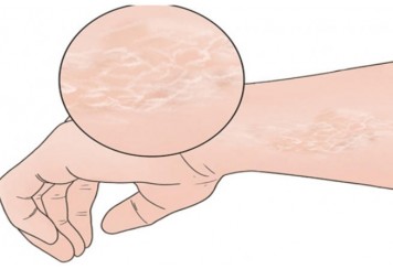 秋季皮肤干燥怎么办